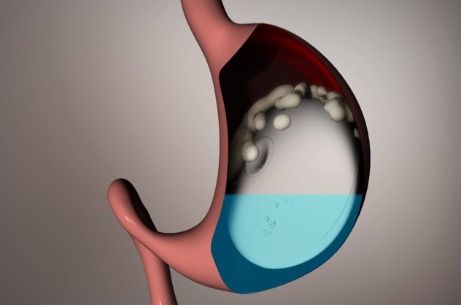 可以吃的減肥氣球膠囊上市，Allurion獲得600萬美元投資