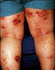 Blog Archives - Obat Penyakit Kulit