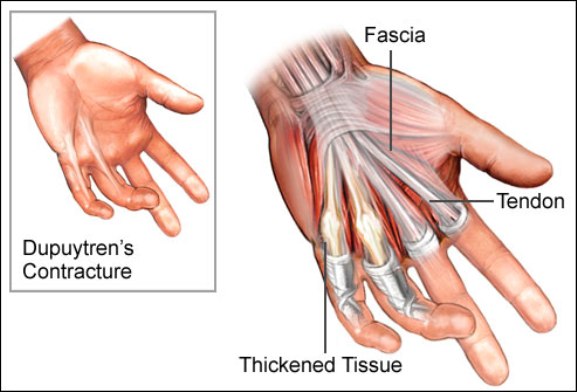 An Illustration of Dupuytren's Contracture