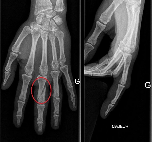 Un Jour En Chirurgie Orthopedique Et Traumatologique Fracture déplacée de la première phalange