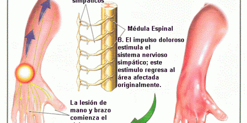 ENFERMEDAD DE SUDECK PDF