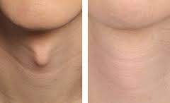 transitioning into tomorrow monday october 24 2016 tracheal