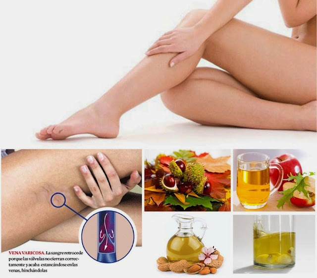 Resultado de imagen para varices en las piernas