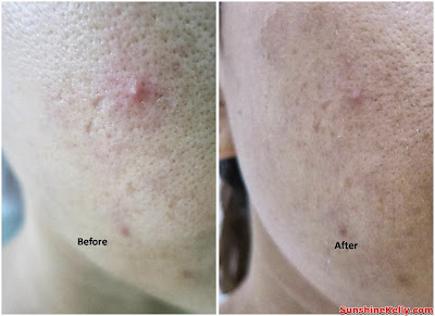 skincare, eucerin, pimples oily combination skin, review, before and after 
