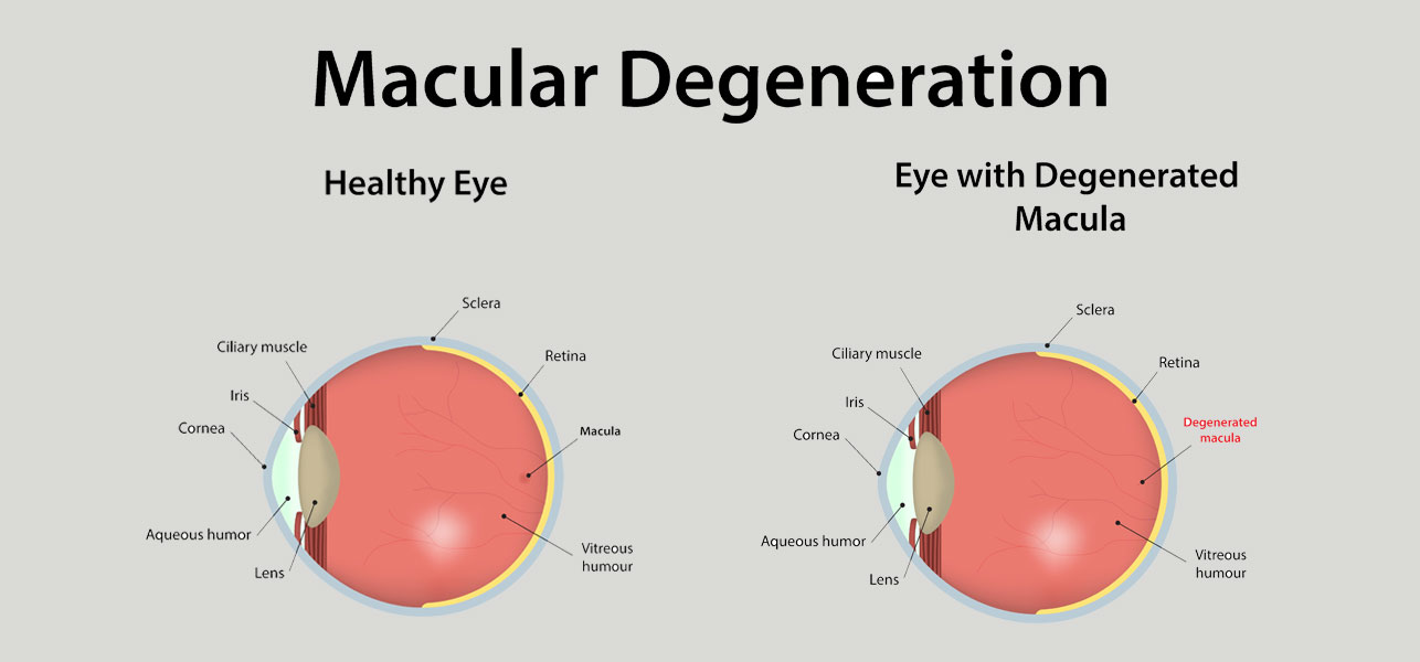 The Health site Macular degeneration