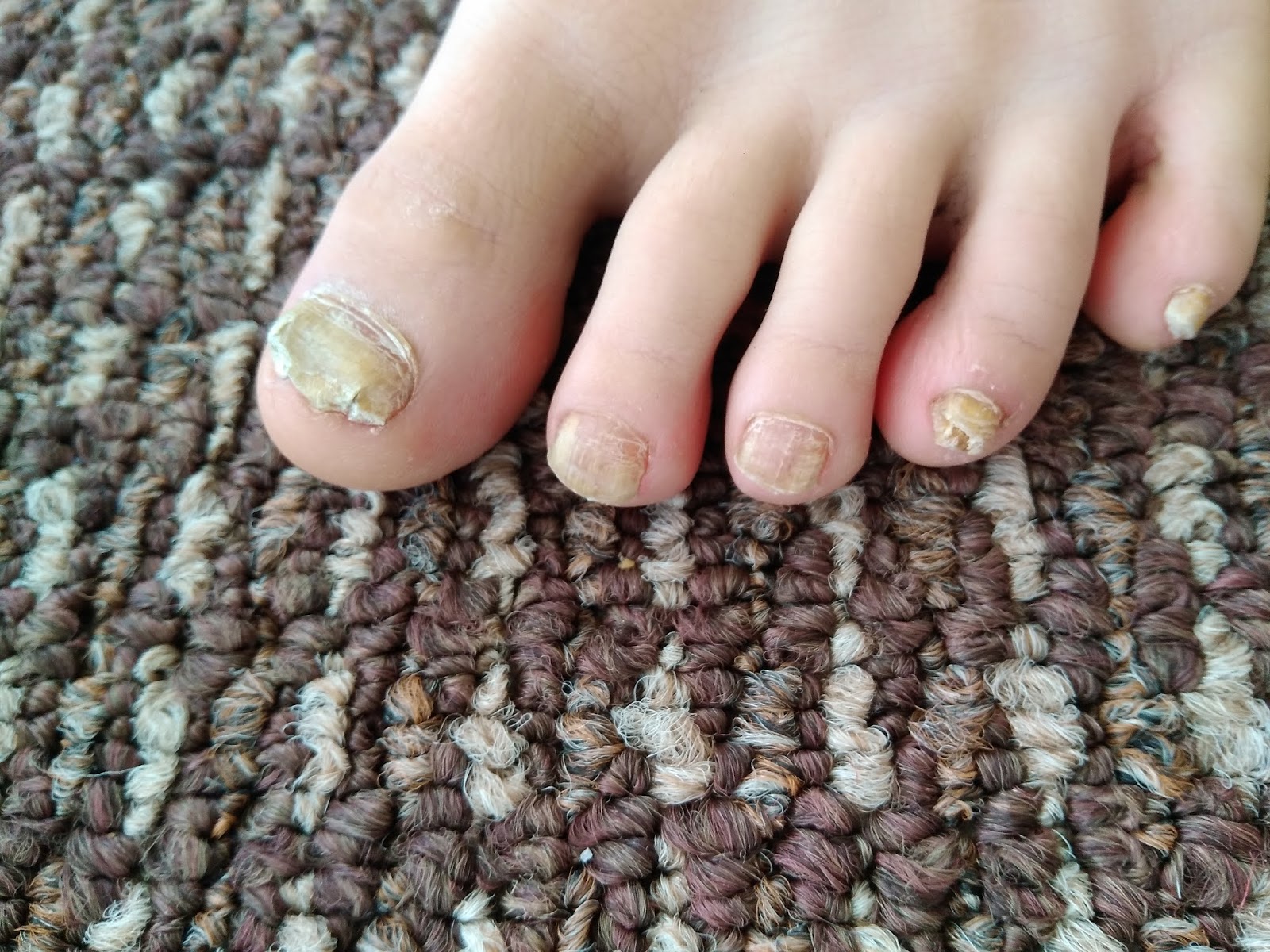 Foot and Ankle Problems By Dr. Richard Blake Toenail Fungus is Among us!!!