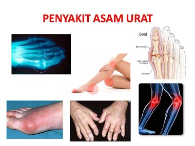 Kenali Asam Urat Lebih Dekat