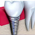 Giải đáp cụ thể: trồng răng implant có đau không?