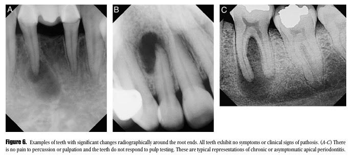 Episode 392/500: endodontic diagnosis and terminology (aae) | all