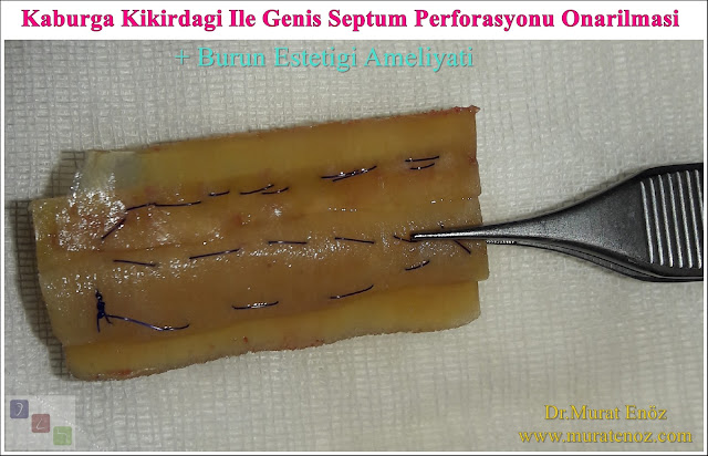 Nazal septum perforasyonu - Septum perforasyonu ameliyatı olanlar - Septum perforasyonu olanlar - Septum perforasyonu ameliyatı yapan doktorlar - Burunda delik oluşumu - Burun duvarında delik - Burun kıkırdak delinmesi tedavisi - Septum perforasyonu ameliyatı olanlar - Septum perforasyonu olanlar - Septal perforasyon tamiri - Septal buton uygulaması - Nazal septum perforasyonu tedavisi - Nazal septum perforasyonu nedenleri - Nazal septum perforasyonu belirtileri - Septum perforasyonun cerrahi onarımı - Burun delinmesinin nedenleri - Nazal septum perforasyonu tanısı - Erkek burun estetiği - Burun estetiği ameliyatı - Definition of Nasal Septal Perforation - Causes of Perforated Nasal Septum - Symptoms of Nasal Septal Perforation - Diagnosis of Nasal Septal Perforation - Surgical Treatment For Nasal Septal Perforation - Nasal Septal Perforation Repair - Surgical Repair of Nasal Septal Perforation