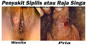 Cara Obat Sipilis Di Apotik Cara Obat Sipilis Di Apotik