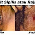 Obat Virus Sipilis