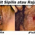 Obat China Sipilis