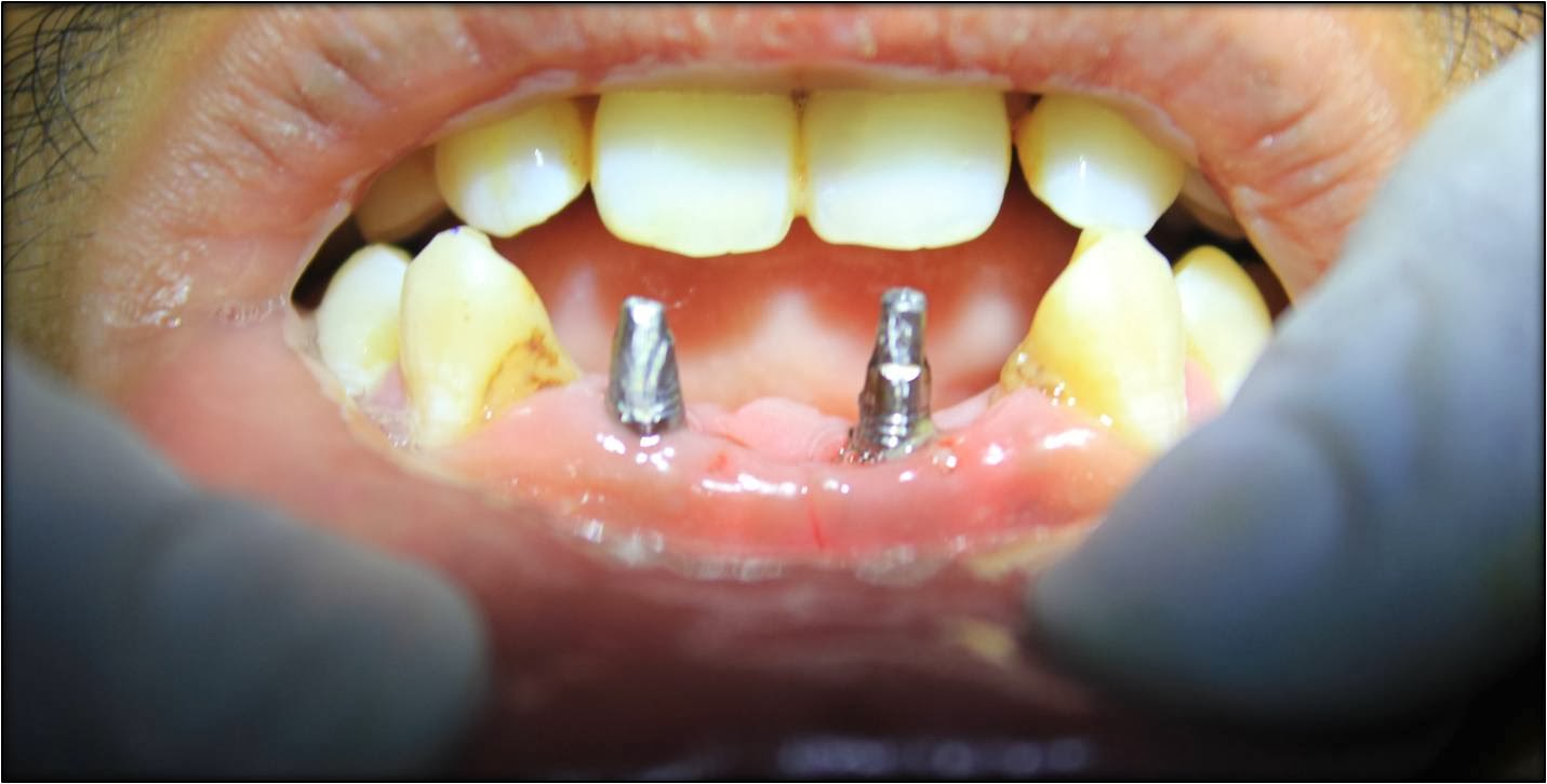 LOOSE BOTTOM FRONT TEETHTreatment by affordable dental implants and
