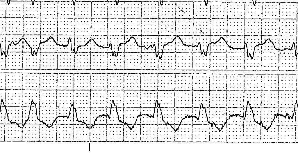 ECG Rhythms WCT VT or Aberrancy?