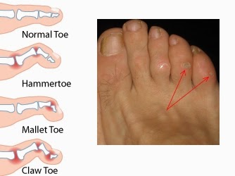 FootMan Podiatry: Corns and Callus (hard skin) - The causes and treatments.