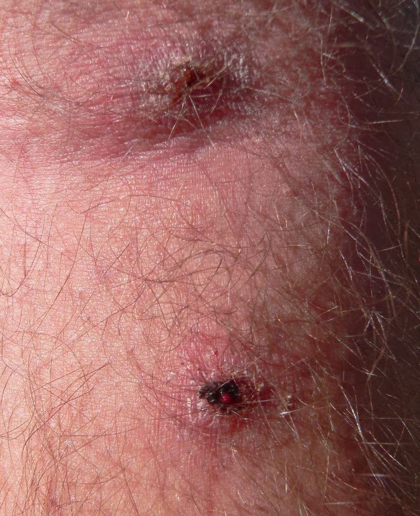 botfly-in-brain