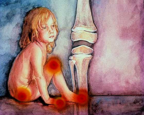 Resultado de imagen de artritis juvenil