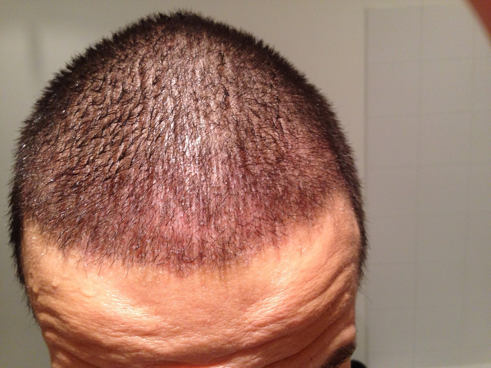 My FUE hair transplant experience 1 month after the FUE hair transplant