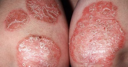 plaque psoriasis contagious vörös kerek foltok a bőrön hámlanak