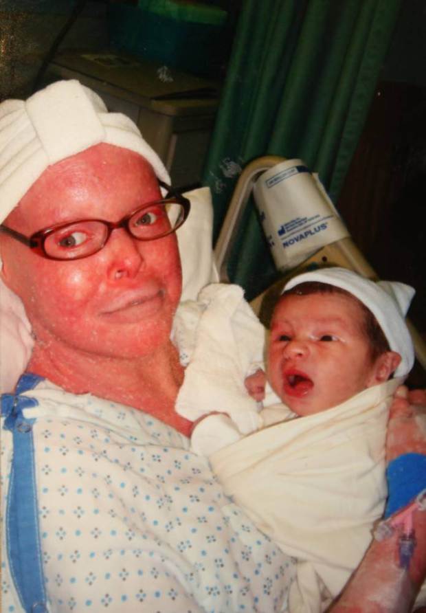 Harlequin ichthyosis also known as Harlequin baby is a severe genetic skin ...