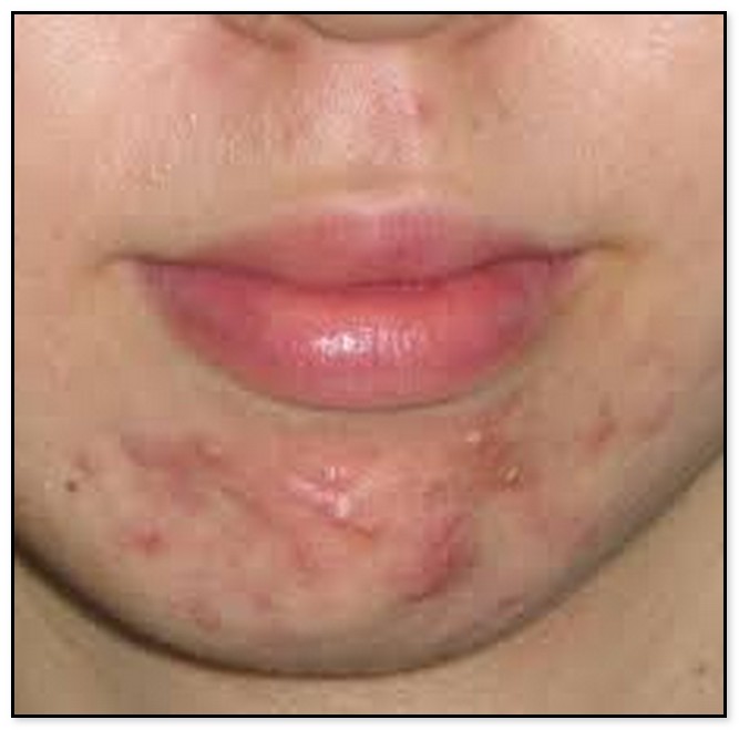 Acne Under Jawline