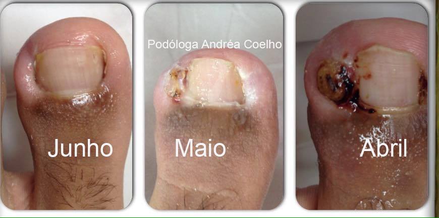 Andrea Coelho Podologia Acessivel Unha Encravada O granuloma piogênico, popularmente conhecido como carne esponjosa, é uma proliferação de vasos sanguíneos que causa uma lesão tumoral secundária a um traumatismo. unha encravada