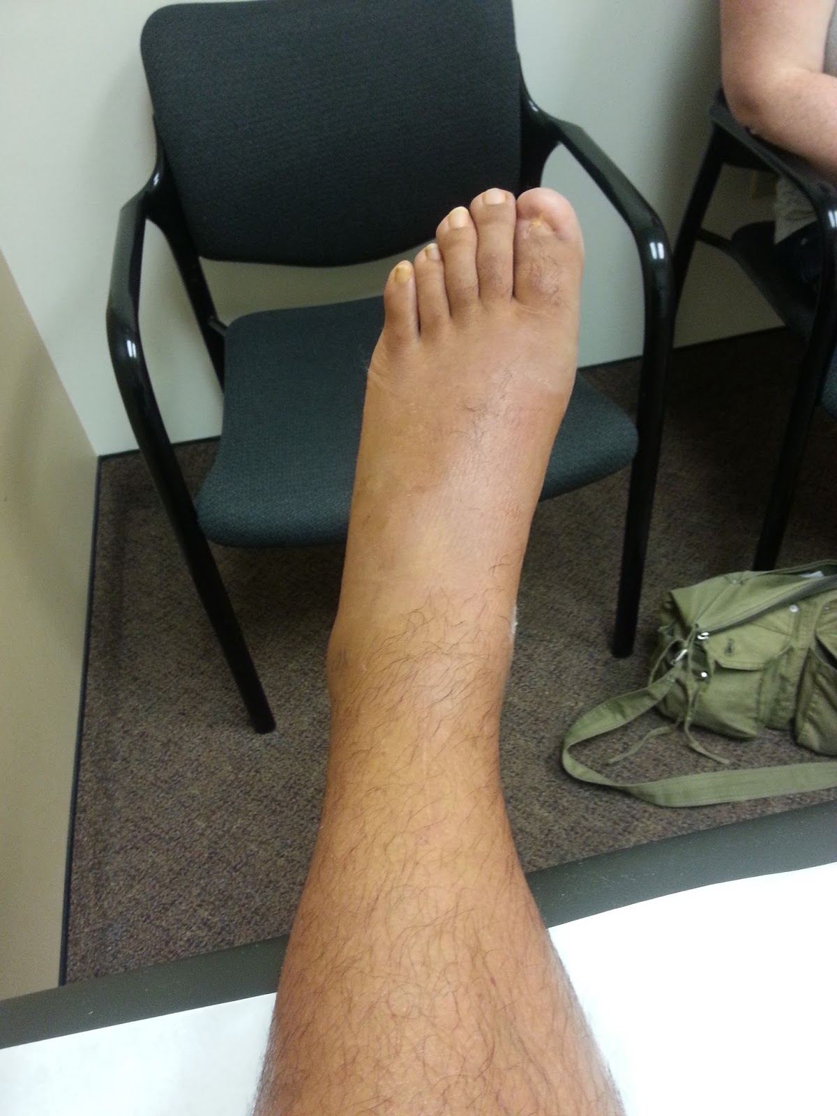 Peroneal Tendon Surgery Recovery Week 2 First PostOp Visit