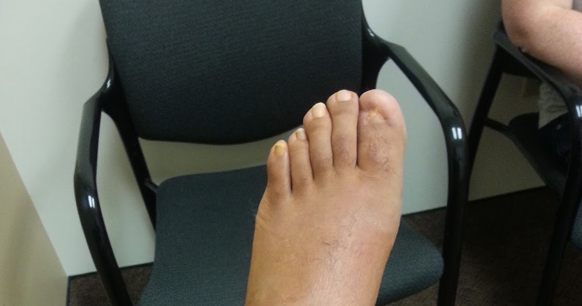 Peroneal Tendon Surgery Recovery Week 2 First PostOp Visit