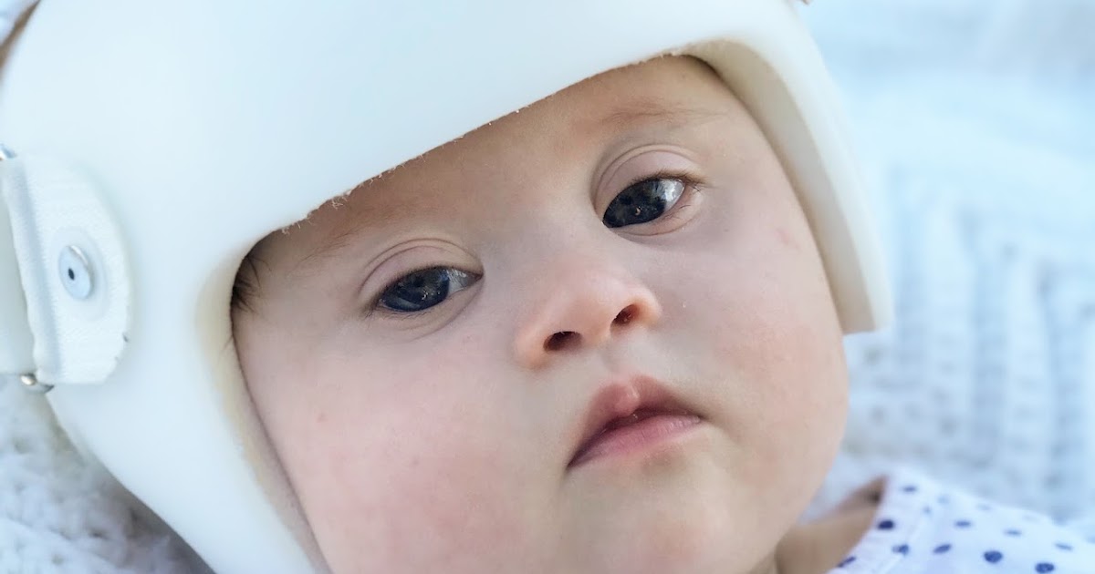 Why Do Down Syndrome Babies Have To Wear Helmets Baby Viewer