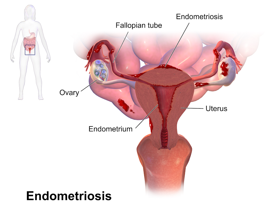imagen endometriosis