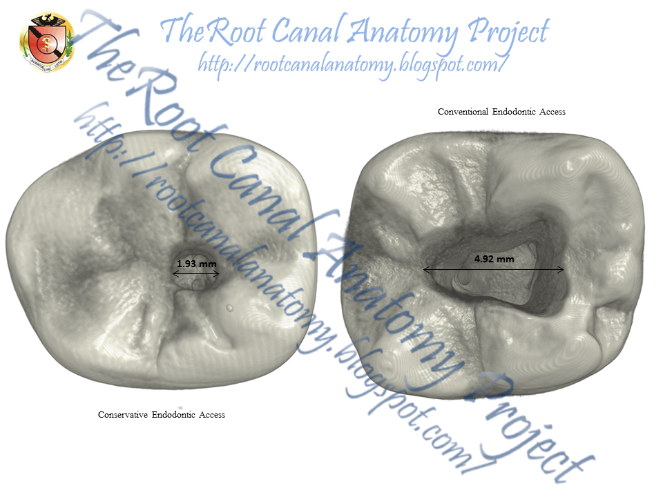 Mandibular First Molar Endo Access