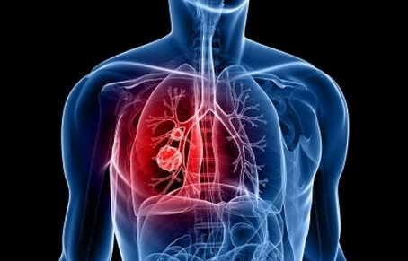 Causes, Symptoms and Characteristics of Lung Cancer