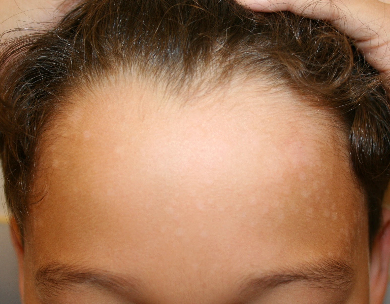 SKIN DISEASE TYPES Tinea Versicolor
