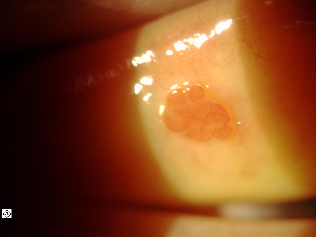 milyen méretű férgek emberi tablettákban papilloma a szemhéj szemén milyen orvos