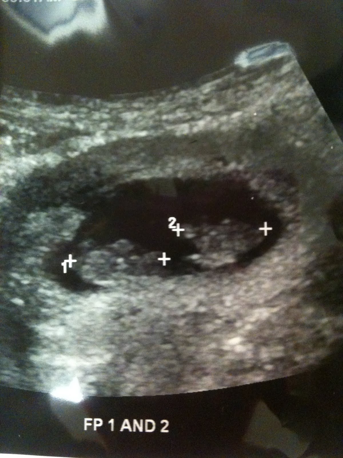 twinsandtoddlerchaos Surprise Again! Your carrying TWINS!!!!