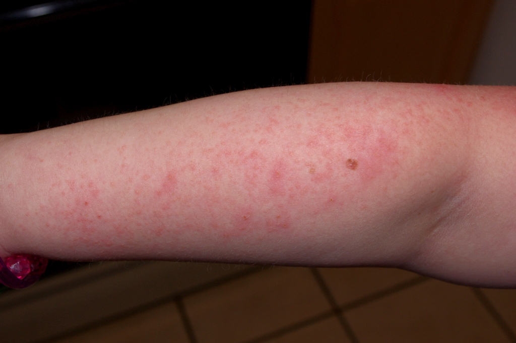 LIFE Marriage, Kids, Dogs, Chickens, and ROHHAD Syndrome Allergic to