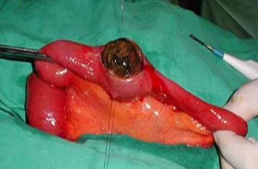 Dr Sherazi Cholecystitis