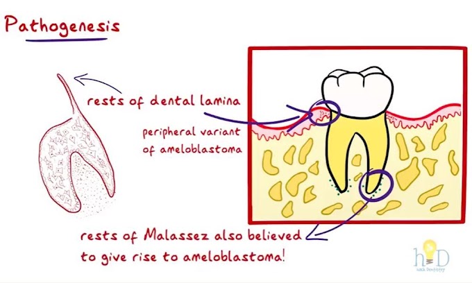 AMELOBLASTOMA: Clinical features, Radiological features, Treatment and Differential Diagnosis