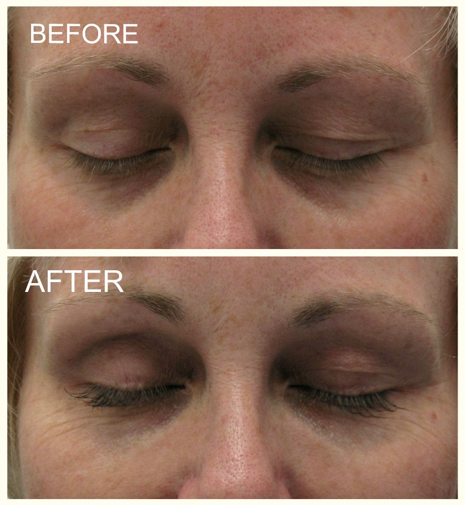 Guelph Medical Laser More Latisse Please!