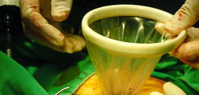 子宮肌瘤肚臍開孔摘除 亞洲首例