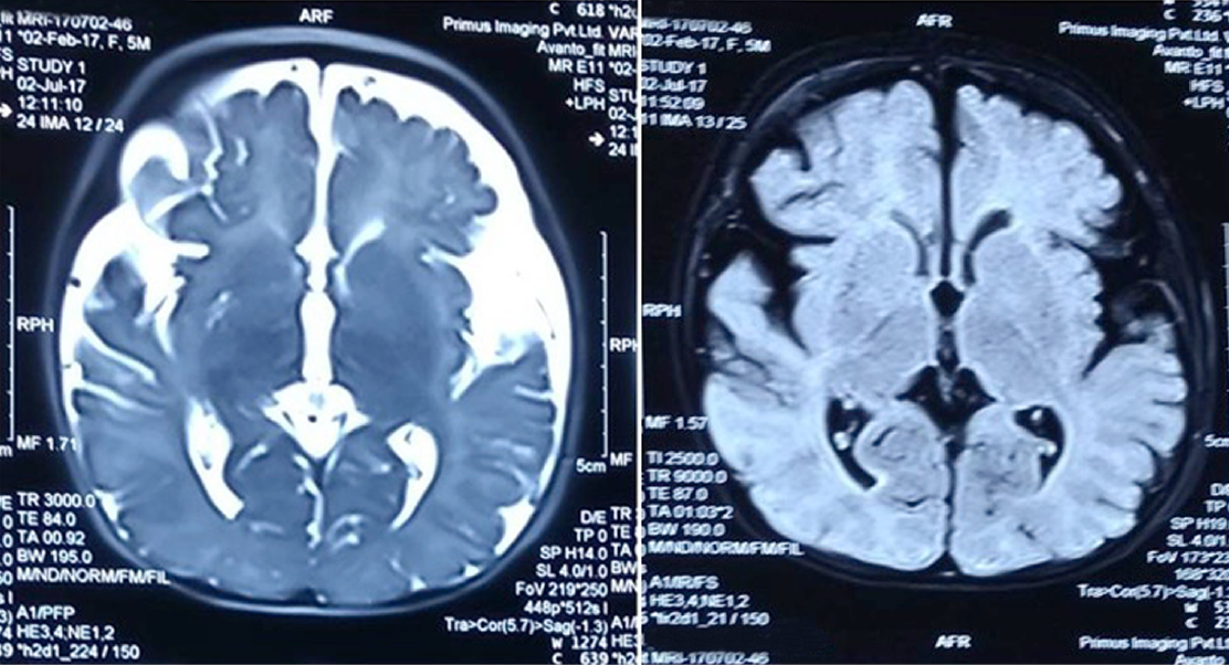 Brain atrophy due to vitamin B12 deficiency in a baby in New Delhi