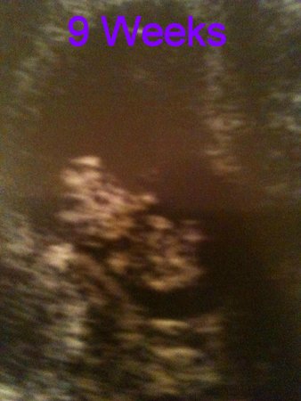 9 week pregnancy scan - ultra sound - first trimester