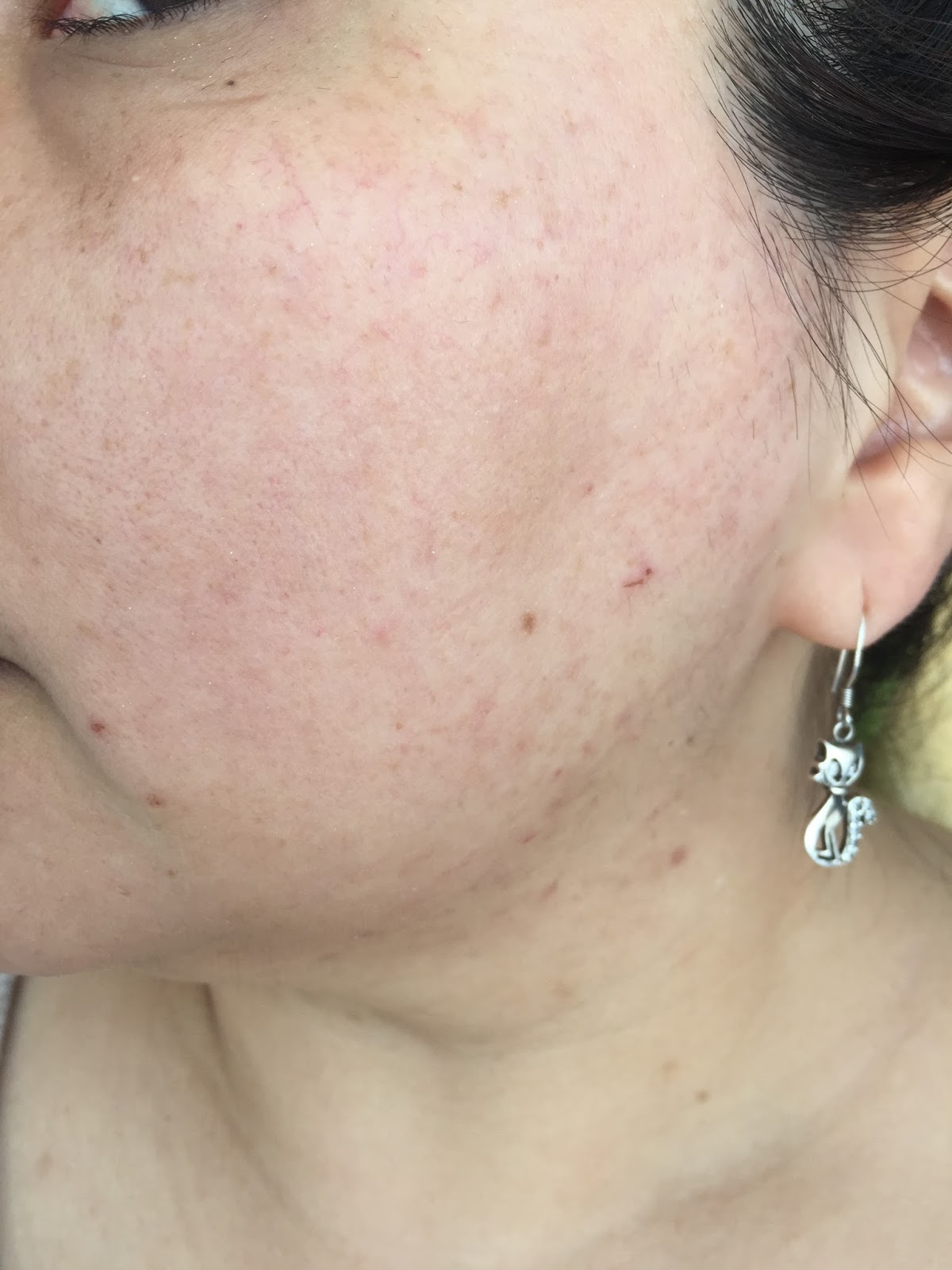 Transform Your Skin: The Big Blackhead Transformation Story - hwcz6qj