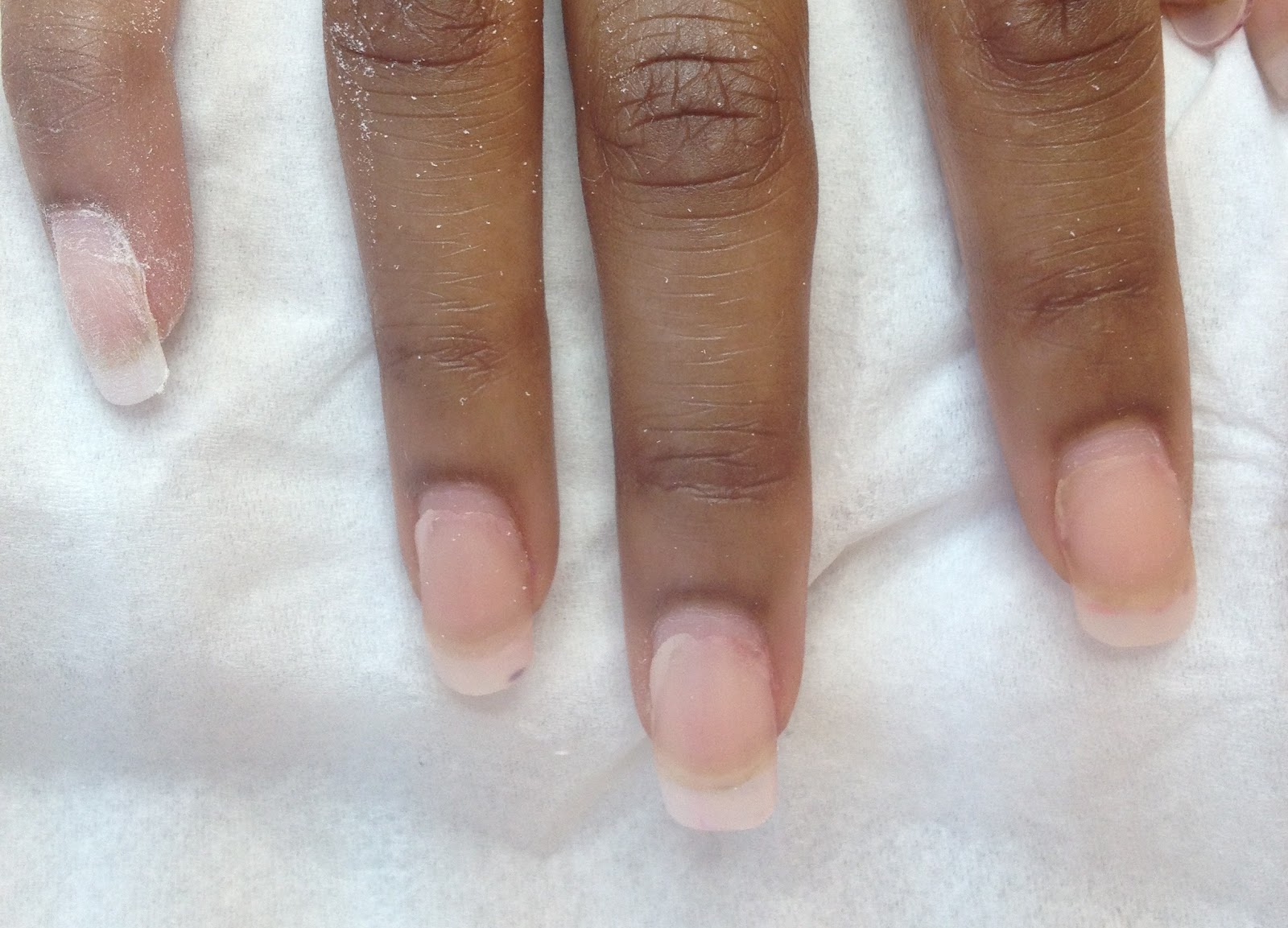 Травматичный онихолизис. Ногти после снятия типс. Ониходистрофия - онихолизис. Отросшие ногти после наращивания. Ногти после наращивания.