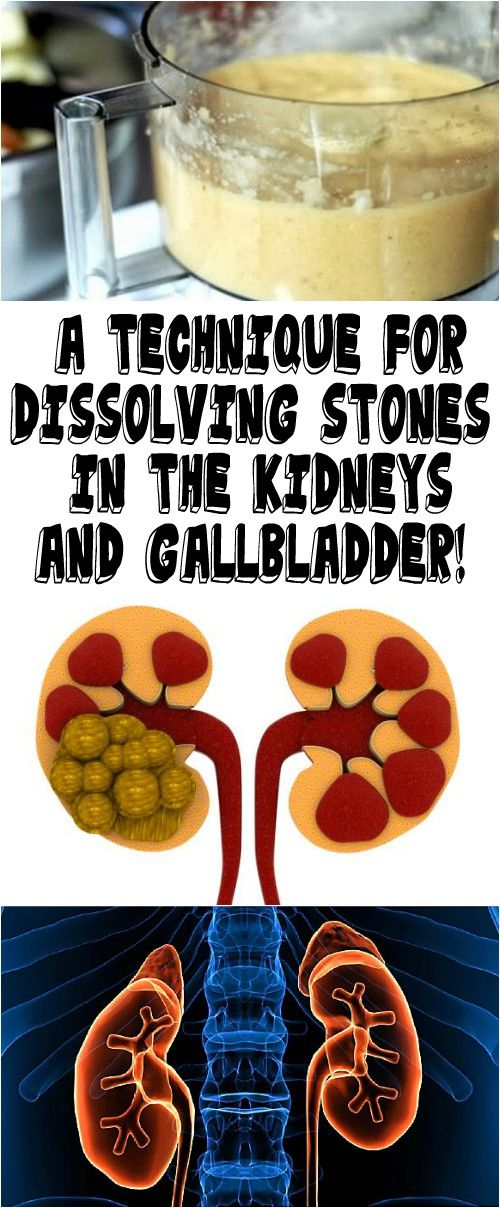 A TECHNIQUE FOR DISSOLVING STONES IN THE KIDNEYS AND ...