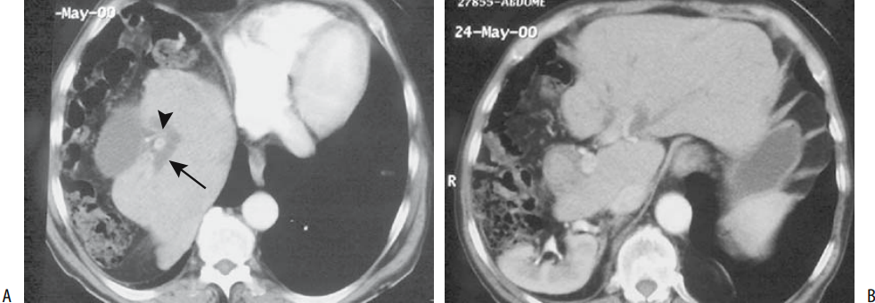 CT Abdomen with contrast Right lobe atrophy. - Radiology Imaging