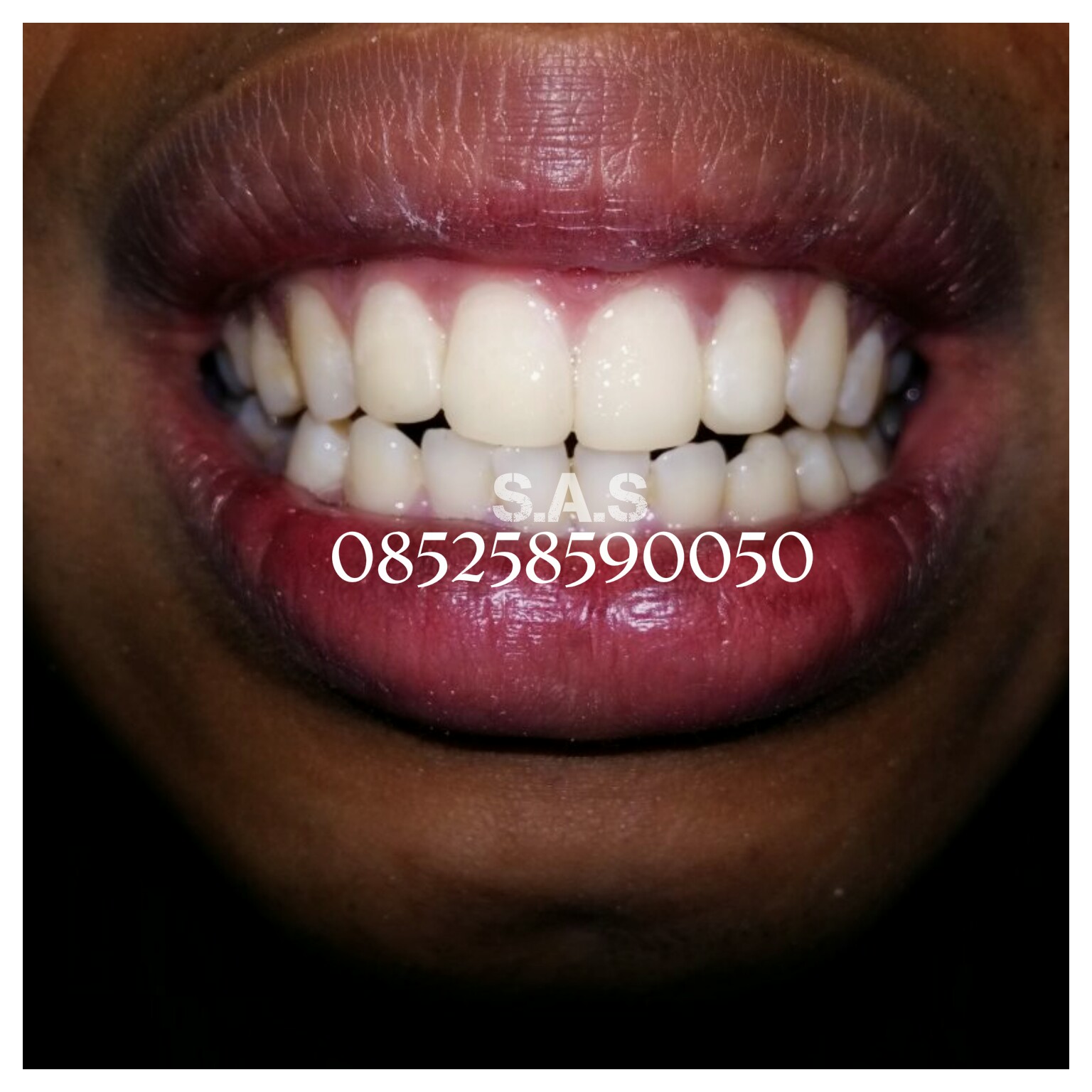 Solusi Merapikan Gigi Renggang Tanpa Menggunakan Behel! Cara Cepat dan ...