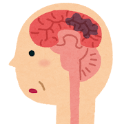 認知症の脳のイラスト（脳血管性）