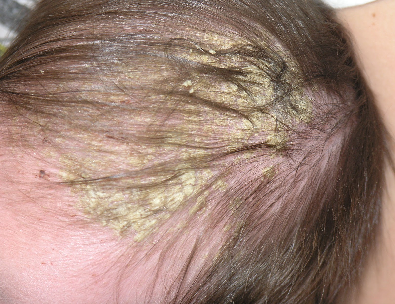 Baby cradle cap pictures, symptoms, causes, and treatments ...